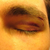 black eye